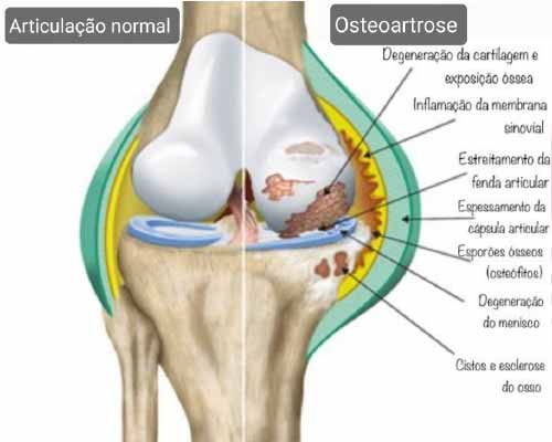 Tratameento Osteoartrose