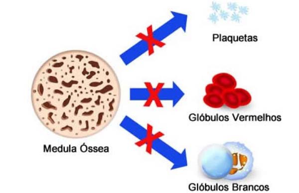 Hipoplasia de Medula